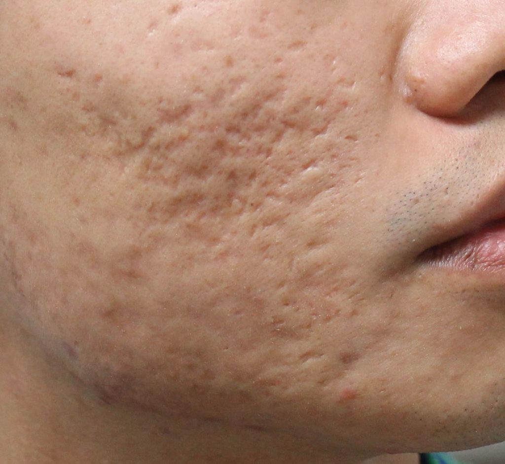 Box scar ระดับหลุมสิว