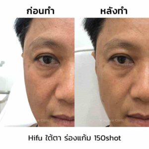review-hifu-ใต้ตา-ร่องแก้ม-150shot