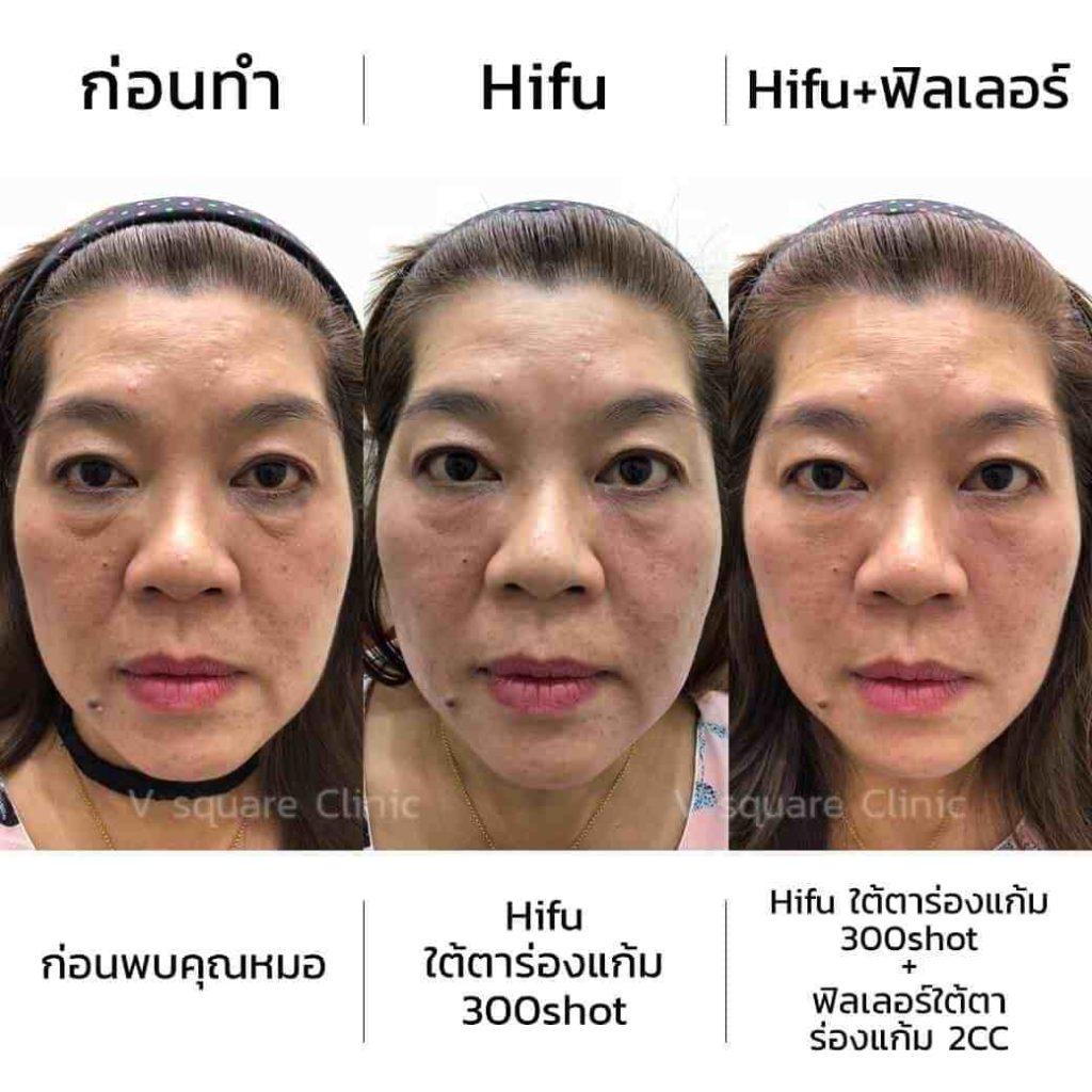 review-hifuใต้ตาร่องแก้ม300shotฟิลเลอร์ใต้ตาร่องแก้