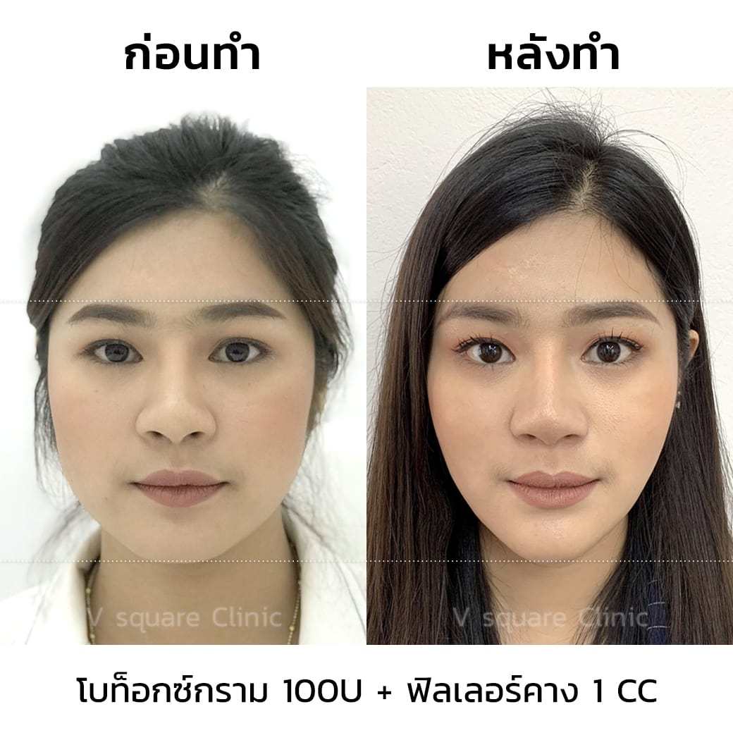 รีวิว ผลการรักษาด้วยโบท็อกลดกรามหน้าเรียว ฟิลเลอร์คาง