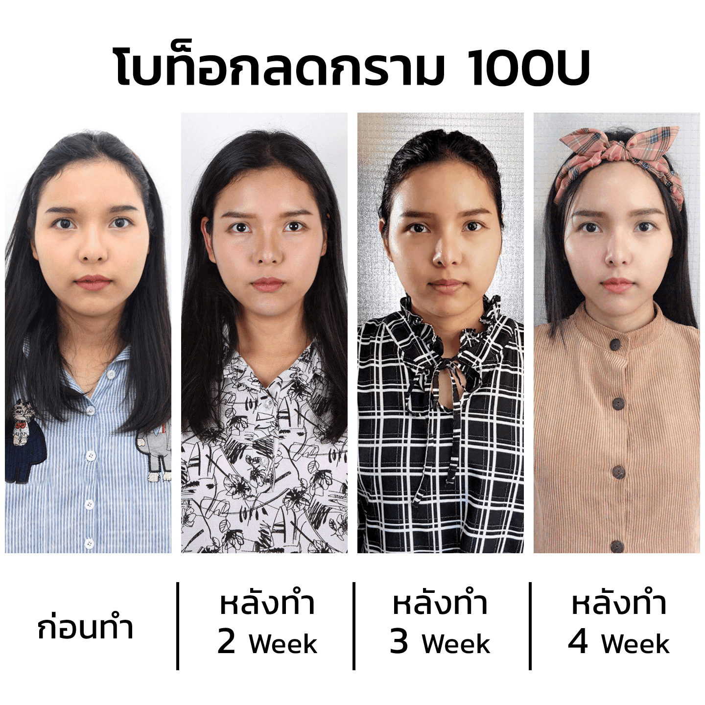 รีวิวโบท็อกลดกรามหน้าเรียว
