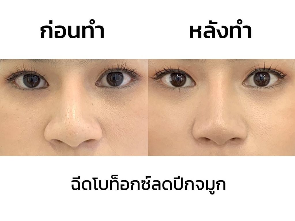 รีวิว-โบท็อกปีกจมูก