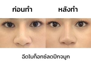 รีวิว-โบท็อกปีกจมูก