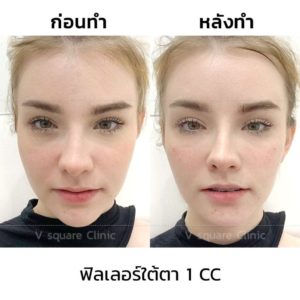 เจสซี่_ฟิลเลอร์ใต้ตา1cc