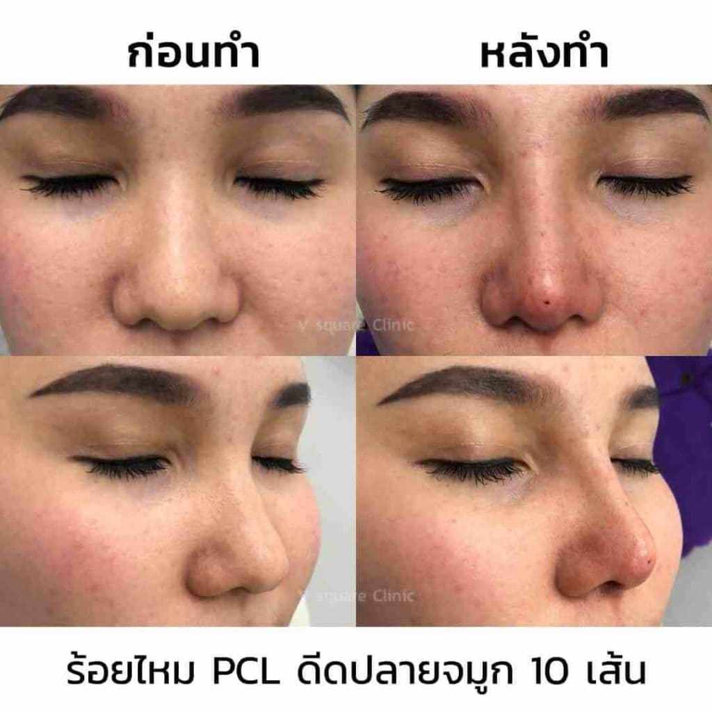 ร้อยไหม-จมูกรีวิว