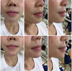 รีวิวฟิลเลอร์คาง