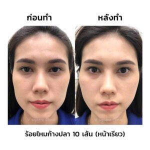 รีวิว ร้อยไหมก้างปลา