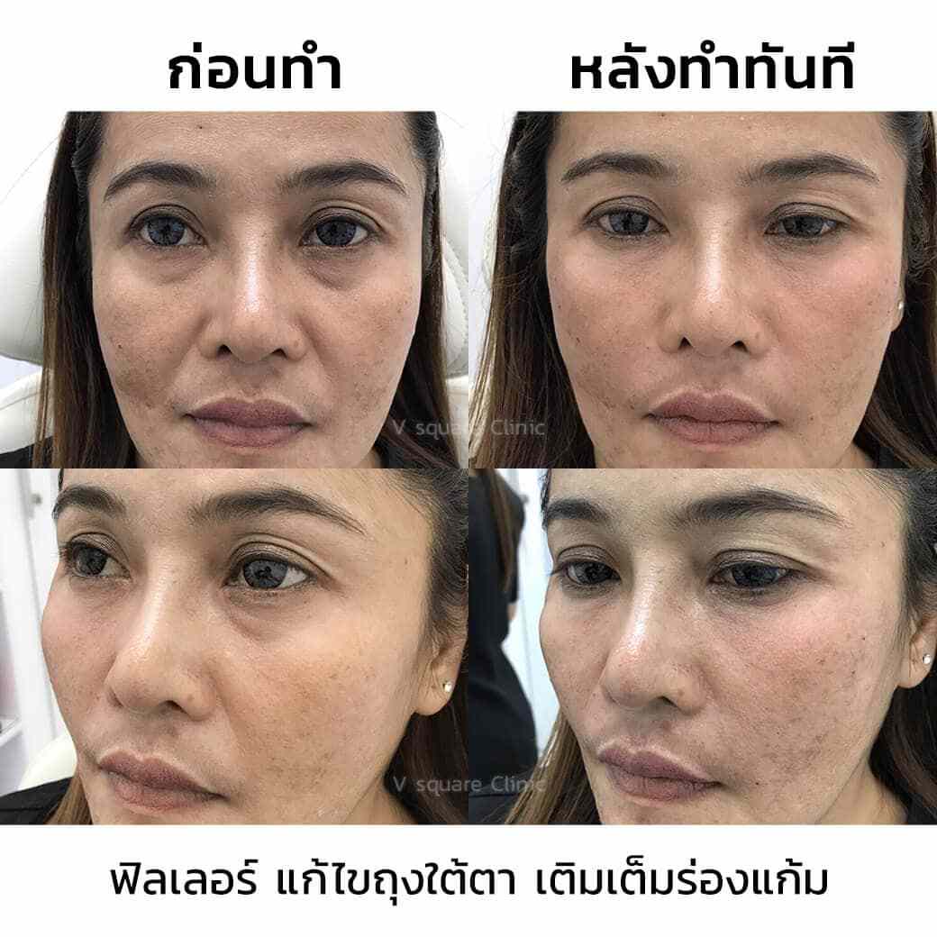 ฉ ดฟ ลเลอร ร องแก ม อ นตรายไหม เล อกฉ ด Filler ย ห อ ร นไหนด