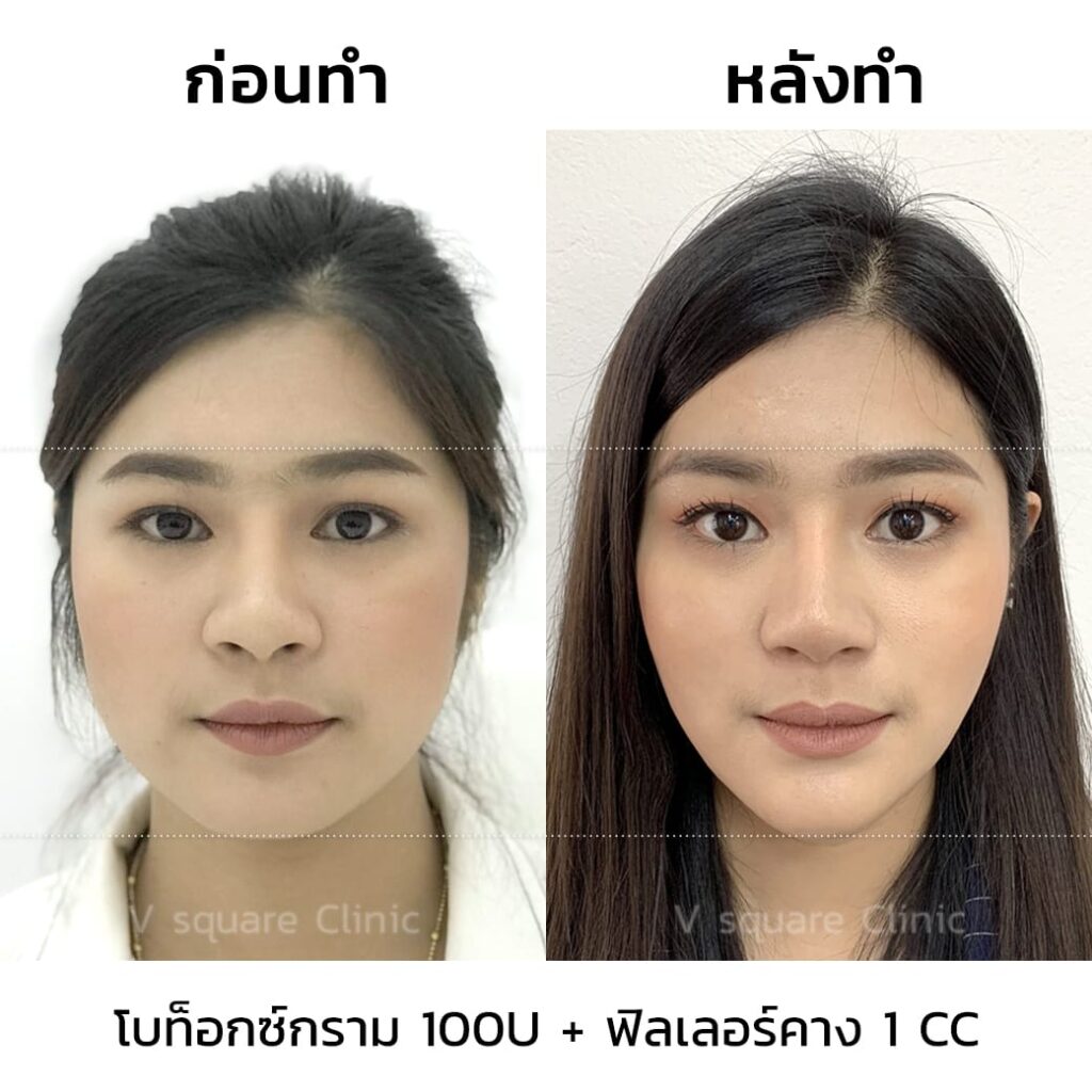 ฉีดโบท็อกกี่วันเห็นผล