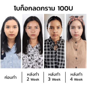 โบท็อกลดกราม 100u