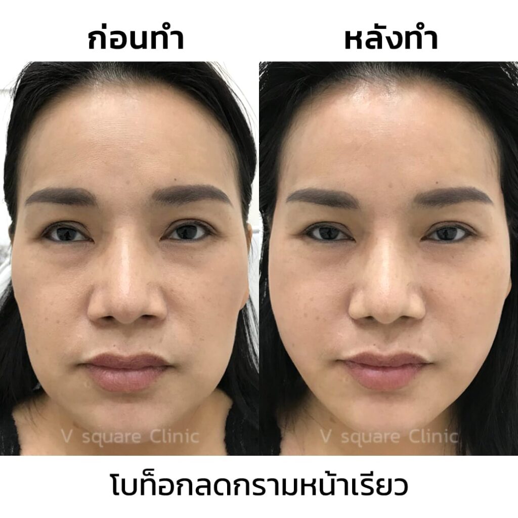 รีวิวโบท็อกลดกรามหน้าเรียว2