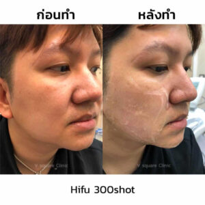 รีวิว-hifu-300shot