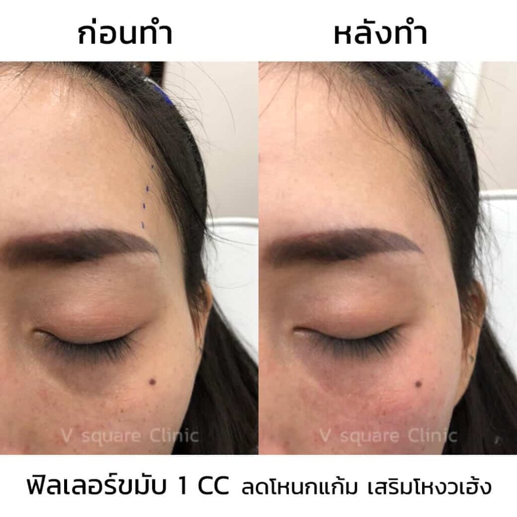 รีวิว ฉีดฟิลเลอร์ขมับ 1cc