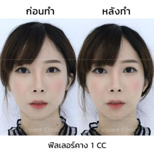 ฉีดฟิลเลอร์คาง 1 cc รีวิว
