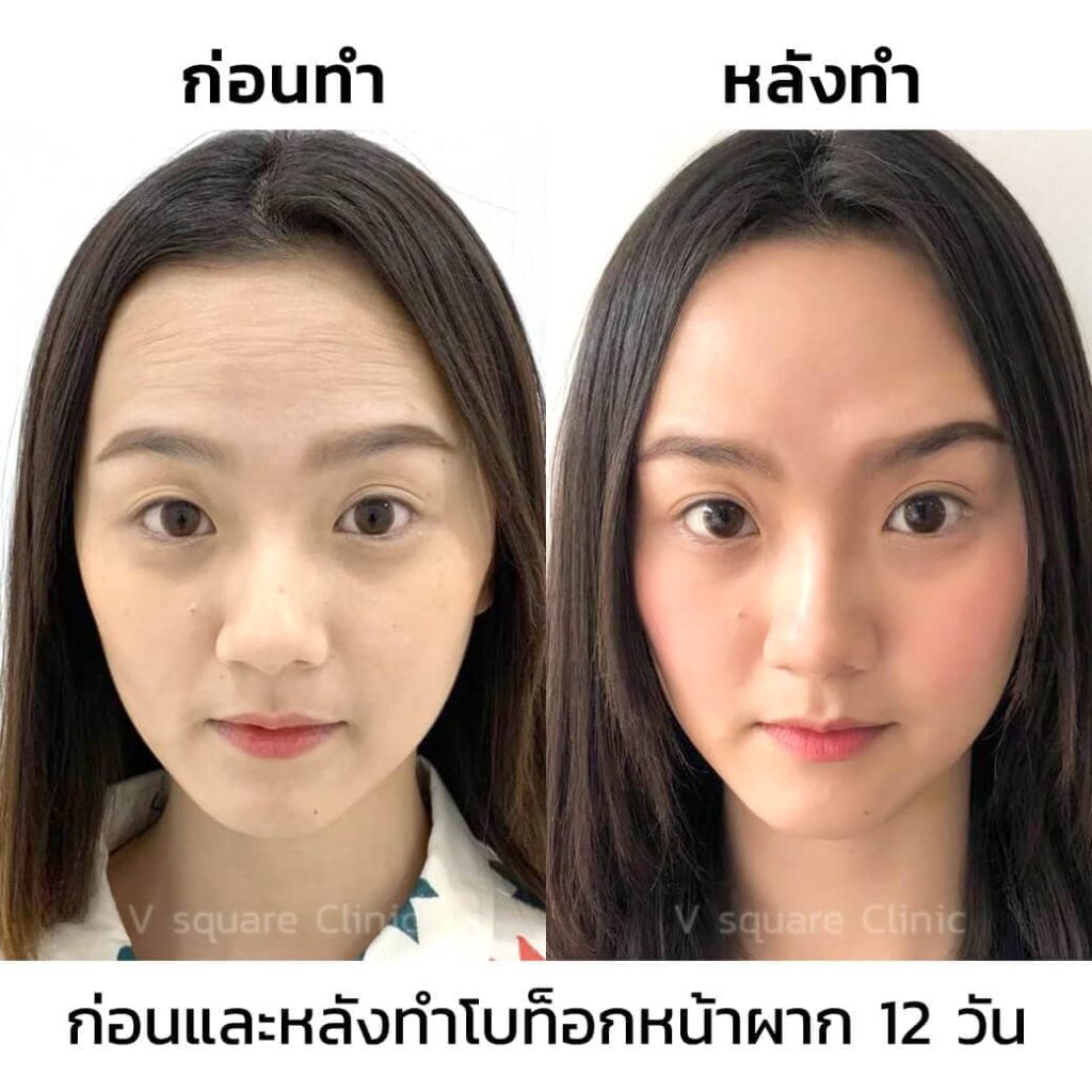 รีวิว ฉีดโบท็อกลดริ้วรอยหน้าผาก