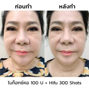 รีวิว ฉีดโบท็อกลิฟหน้า