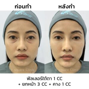 รีวิวฉีดฟิลเลอร์ใต้ตา