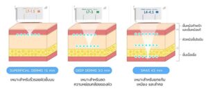 ระดับความลึกของหัวยิง-Ulthera